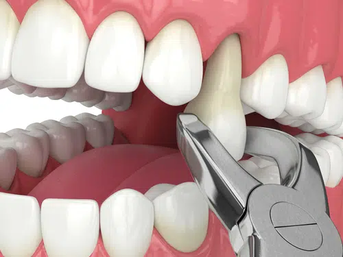 Safe and gentle tooth extractions in Ladson, SC