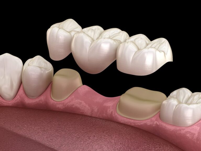 tooth extraction in Ladson clinic
